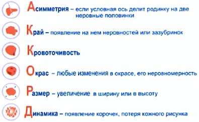 асимметрия - если условная ось делит родинку на две неровные половинки