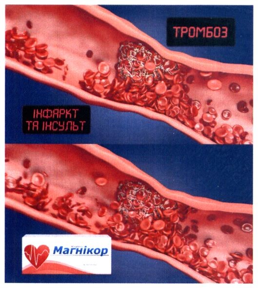 інфаркт та інсульт
